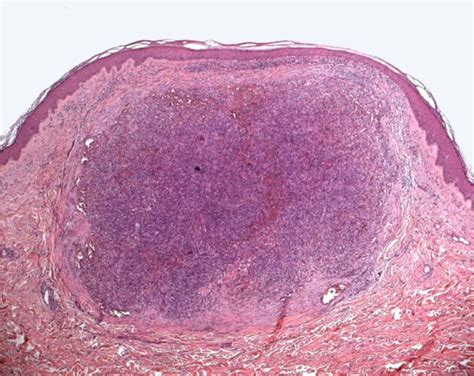 Histology of Classic Kaposi Sarcoma (hematoxylin and eosin, 4X ...