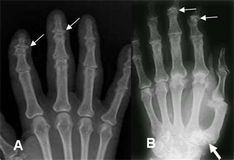 ARTROPATIA NEUROPATICA Cirugia De Columna En Matamoros