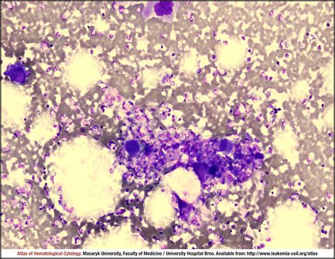 Polycythaemia Vera PV CELL Atlas Of Haematological Cytology