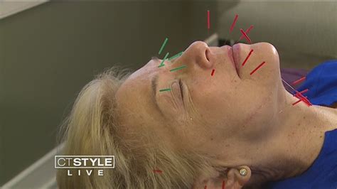 Facial Rejuvenation Acupuncture A Natural Way To Get Rid Of Wrinkles Youtube