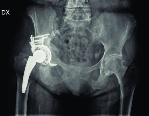 X Ray After Acetabular Revision Surgery Pelvis Ap View Download