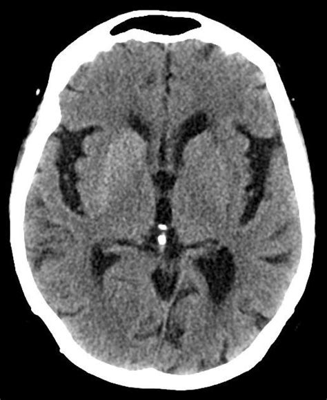 Hemichorea-hemiballismus syndrome without damage to the subthalamic ...