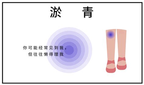 为什么女生身上总会青一块紫一块？科普健康160资讯网