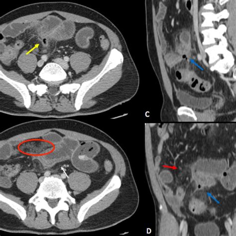 Acute Epiploic Appendagitis In Two Different Patients A B Sagittal