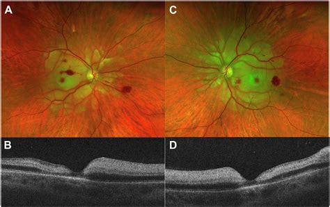 Hellp Syndrome Associated Purtscher Like Retinopathy Ophthalmology