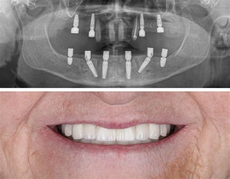 Factor de crecimiento la solución para los implantes dentales en