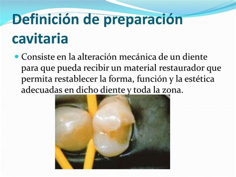 Ppt Conceptos Basicos De Cavidades Dentales Powerpoint Presentation