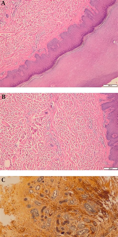 Epidermal Hyperorthokeratosis B Thickening Of The Dermis With