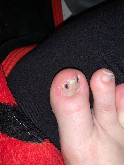 Nail broke, became ingrown. Trimmed the sharp part off 2 weeks ago but