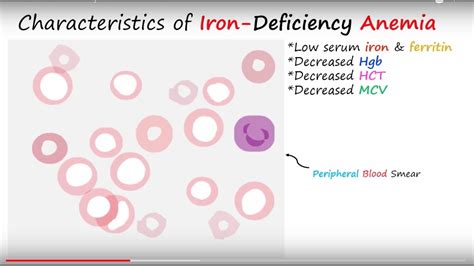 Stages Of Iron Deficiency Anemia