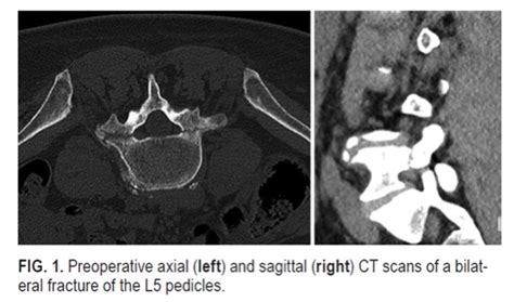 Pedicle Fracture