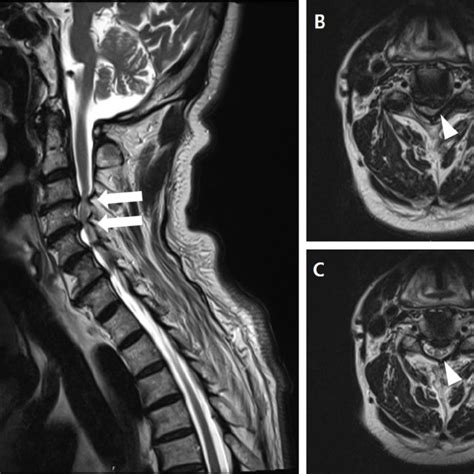 Pre Operative Magnetic Resonance Images Of Cervical Spine In 72 Years