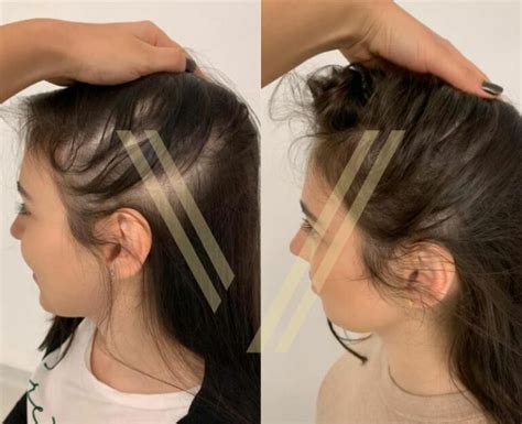 Haartransplantation Bei Frauen In Der T Rkei Preise