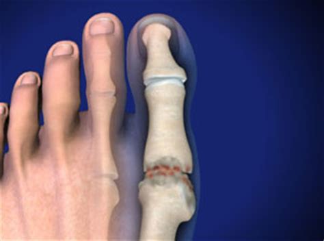 Treating Hallux Rigidus in Plano, Frisco, McKinney and Allen