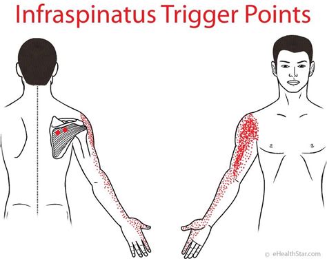 Infraspinatus Trigger Points On Anatomyinfraspinatus Muscle Trigger