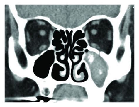 X Ray Sinus Mold