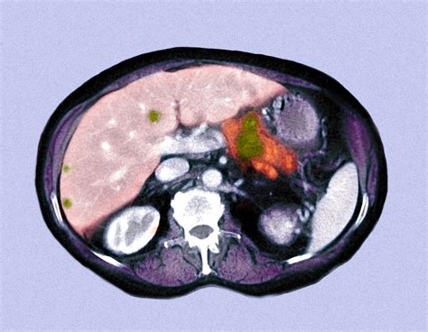 Metastatic Pancreatic Cancer Ct Scan 2 Photograph By Du Cane Medical