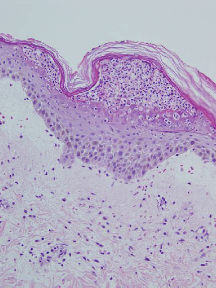 Acute Generalized Exanthematous Pustulosis Histopathology Demonstrates