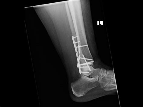 Ortho Dx Chronic Ankle Pain Following Surgery Clinical Advisor