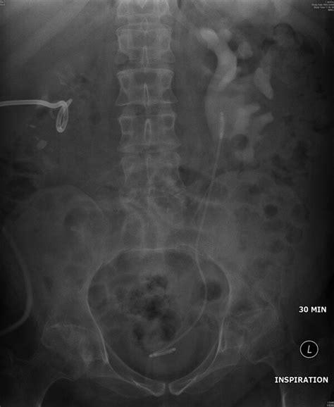 Intravenous Urography 18 February 2008 30 Minutes Film Showed