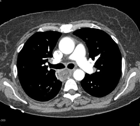 Severe Esophagitis In Oncology Patient Esophagus Case Studies