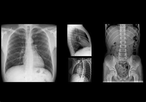 胸部、腹部レントゲン：注釈付き正常x線画像 E Anatomy