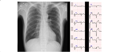 Chest X Ray And Electrocardiogram Results The Chest X Ray Results Were