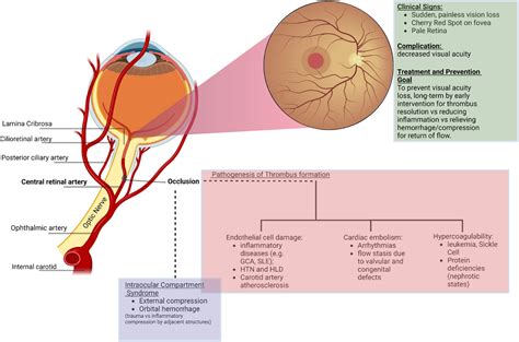 Central Retinal Artery Occlusion A Review Of Pathophysiological