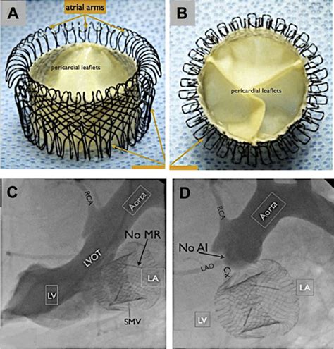 Percutaneous Transcatheter Mitral Valve Replacement Circulation