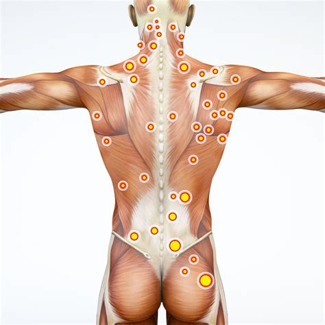 Trigger Points and Trigger Point Therapy – HealthWorks