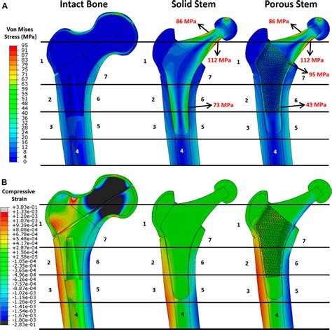 Frontiers A Novel Hybrid Design And Modelling Of A Customised Graded Ti 6al 4v Porous Hip