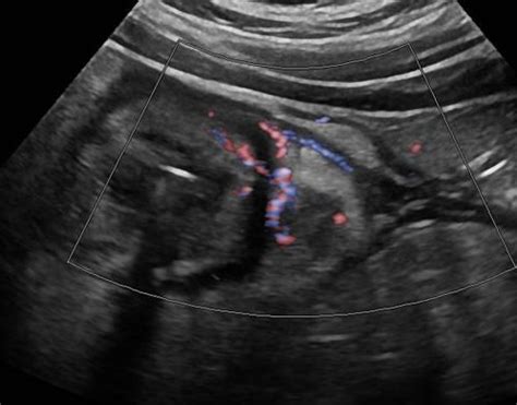 Abdomen and retroperitoneum | 1.6 Gastrointestinal tract : Case 1.6.1 Diverticulosis and ...