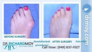 Dr Richard Moy Dpm Painless Bunion Surgery Board Certified Surgeon