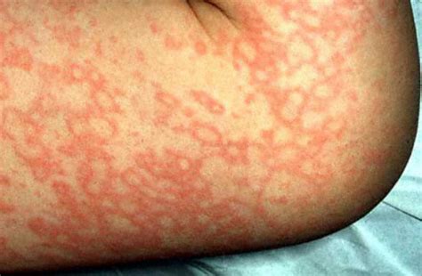 Maculopapular Rashes Causes With Pictures