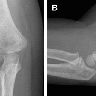 Representative X-ray of a fracture of the lateral condyle (a) even not ...