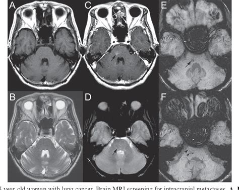 Figure From Susceptibility Weighted Imaging In Diagnosing Brain