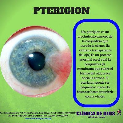 Clínica de Ojos Oftalmic Láser PTERIGION