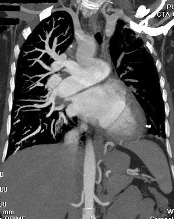 Unilateral Pulmonary Artery Atresia Radiology Case Radiopaedia Org