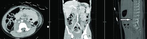 Computed Tomography Ct Abdomen And Pelvis Taken At The Outside