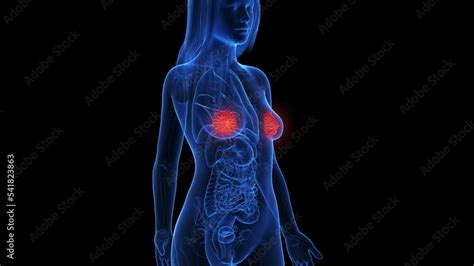 3d Rendered Medical Animation Of Inflamed Mammary Glands Stock Video