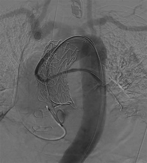 Angiogram Showing Patent Viabahn Chimney Stent Graft In Free Vein