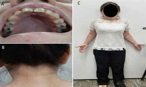 Clinical Features Of Turner Syndrome Including A High Arched “ogival” Download Scientific