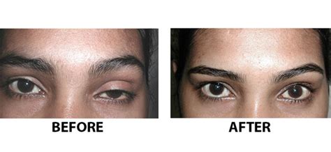 Hooded Eye Botox Eyebrow Lift: Everything You Need To Know