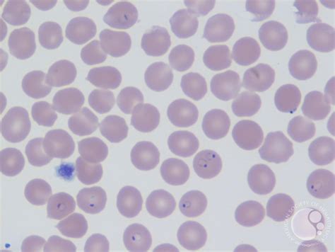 Plasmodium Falciparum