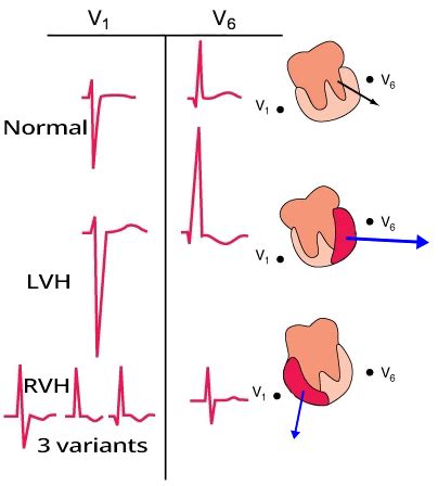 Biventricular Hypertrophy Ecg Book