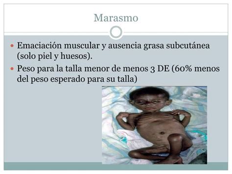 Desnutrición Marasmo Kwashiorkor PPT