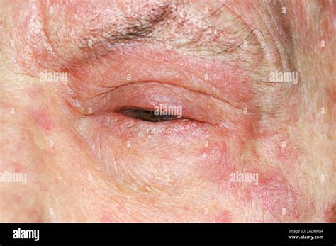 Shingles Rash Round The Eye Of A 76 Year Old Man Shingles Herpes