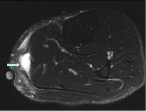 Figure 4 From Ultrasound And Mri Findings Of Tennis Leg With