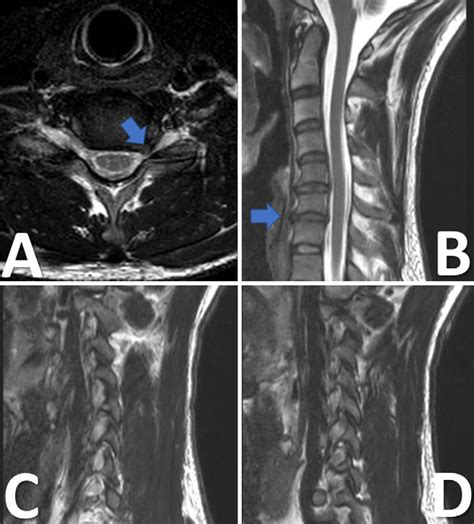 Preoperative Cervical MRI A Axial T2 Weighted View Showing A Left