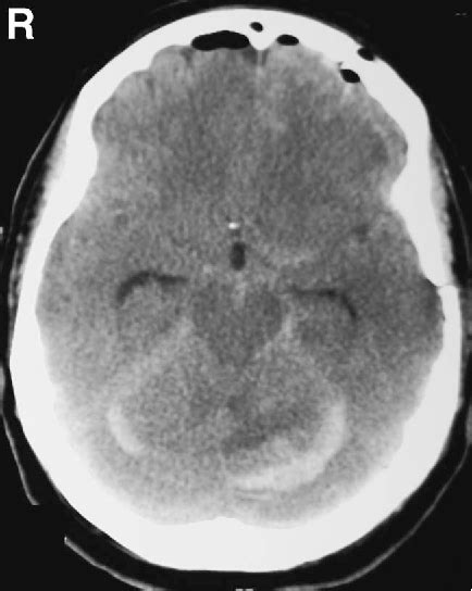 Figure 4 From Remote Cerebellar Hemorrhage Zebra Sign In Vascular Neurosurgery